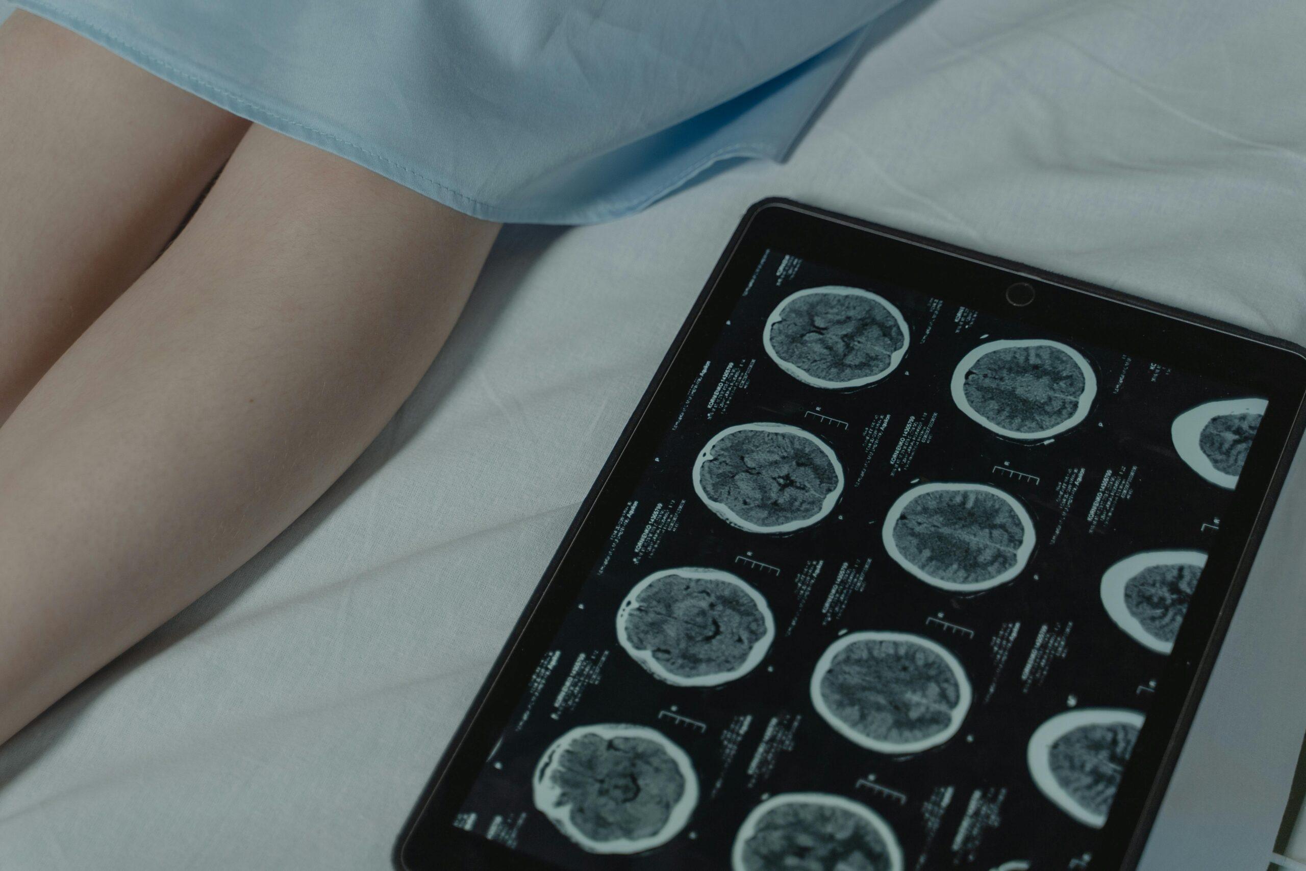 When & Why You Need a Florida Brain Injury Attorney After a Car Crash 